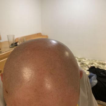 Skalp Los Angeles - Before - Hair Loss Centers Near Me - Westminster, California