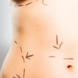 Orlando Massage Clinic - Lymphatic massage and compression garment fittings