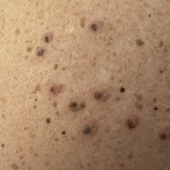 Scott D Glazer, MD - Close up of some of the moles on my back that liquid nitrogen was used on. - Dermatologists Near Me - Arlington Heights, Illinois Scott D Glazer, MD - Close up of some of the moles on my back that liquid nitrogen was used on. - Dermatologists Near Me - Arlington Heights, Illinois