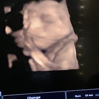 Fertilite - 4D ultrasound - Fertility Near Me - Tijuana, BCN