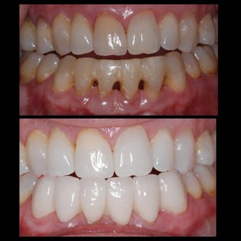 Brandon L Cairo, DMD, PC - Goodbye black triangles, Hello beautiful smile! - General Dentistry Near Me - Worcester, Massachusetts
