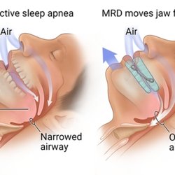 Steven Wilk, DDS - Denver Sleep Apnea Center - Appliance works by gently holding your lower jaw forward while sleeping opening your airway. It's similar to the jaw thrust maneuver in CPR.
