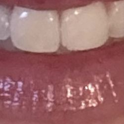 Sawgrass Complete Dentistry - Tooth before bonding procedure