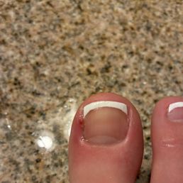 This is the day after the pedicure. This is the day after the pedicure.