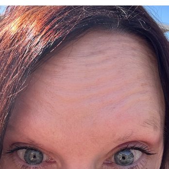 Young Again Cosmetic Injections - Before treatment - Aestheticians Near Me - Scottsdale, Arizona Young Again Cosmetic Injections - Before treatment - Aestheticians Near Me - Scottsdale, Arizona