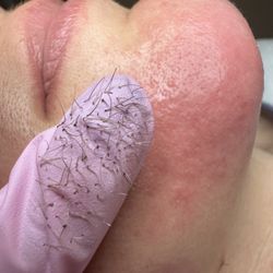 Vanish Electrolysis