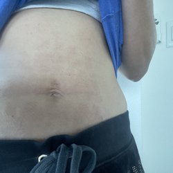 Skinfuzion - Morpheus eight laser damaged by Kim