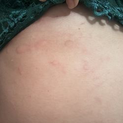 San Marcos Motel - This is just one area I had some bites in my neck, stomach and arms. :/