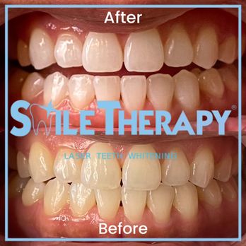 Smile Therapy - Teeth Whitening! - Teeth Whitening Near Me - Clovis , California Smile Therapy - Teeth Whitening! - Teeth Whitening Near Me - Clovis , California