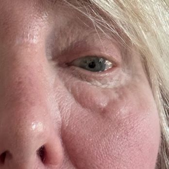 Hootan Daneshmand, MD - After my eye surgery with Dr. Daneshmand, uneven lumps and eye pain - Cosmetic Surgeons Near Me - Foothill Ranch, California Hootan Daneshmand, MD - After my eye surgery with Dr. Daneshmand, uneven lumps and eye pain - Cosmetic Surgeons Near Me - Foothill Ranch, California