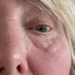 Hootan Daneshmand, MD - After my eye surgery with Dr. Daneshmand, uneven lumps and eye pain