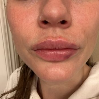 Wildrose Aesthetics - 1 hr After injection - Laser Hair Removal Near Me - Newport Beach, California Wildrose Aesthetics - 1 hr After injection - Laser Hair Removal Near Me - Newport Beach, California