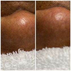 Glam Spa | Skin Gym - Blackhead Removal. Let us unclogged your pores!