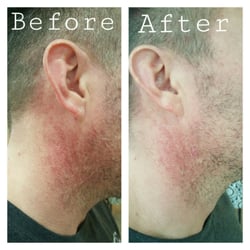 Selah Studio - UV induced Hyperpigmentation - results after 5 days.