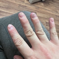 Orchid Nail Spa - Waiting in exam room at urgent care to be treated for chemical burns, bacterial, and fungal infections!