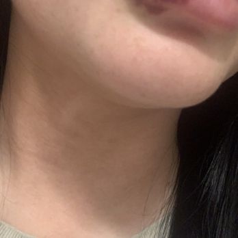 Steven K Struck, MD - Busted blood vessel. Bruised for 4 weeks - Cosmetic Surgeons Near Me - Atherton, California Steven K Struck, MD - Busted blood vessel. Bruised for 4 weeks - Cosmetic Surgeons Near Me - Atherton, California
