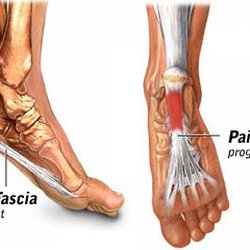 Richard L Lizerbram, DPM - Heel pain is an extremely common and potentially disruptive affliction that has many possible causes. Plantar fasciitis is the most common.