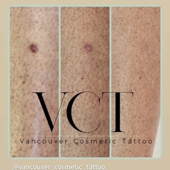 Vancouver Cosmetic Tattoo - Dark Scar Camouflage - Tattoo Near Me - Vancouver, British Columbia Vancouver Cosmetic Tattoo - Dark Scar Camouflage - Tattoo Near Me - Vancouver, British Columbia