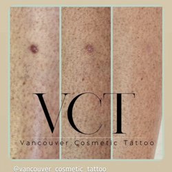 Vancouver Cosmetic Tattoo - Dark Scar Camouflage
