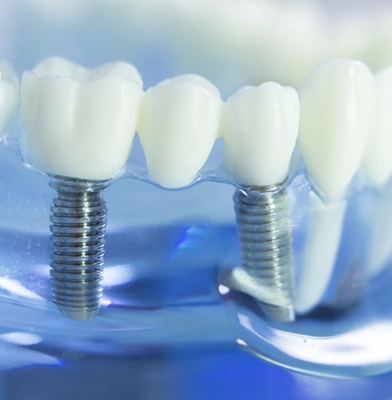 Lasting Dental Implants - Restore Your Smile with State-of-the-Art Dental Implants.

Experience the gold standard in tooth replacement at Aden Dental with our modern dental implant solutions. We combine thorough planning, advanced 3D imaging, and top-tier implant systems to deliver natural, functional, and lasting results. Regain your smile’s appearance and performance with personalized care from our implant team.
