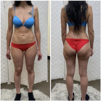 Sweet Curves - 18 sessions total of post op massages for this gorgeous client!
Work by Dr. Nykiel at SoCal Plastic Surgeon in Newport Beach - Body Contouring Near Me - Irvine, California Sweet Curves - 18 sessions total of post op massages for this gorgeous client!
Work by Dr. Nykiel at SoCal Plastic Surgeon in Newport Beach - Body Contouring Near Me - Irvine, California
