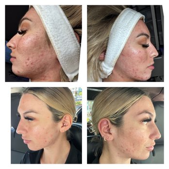 Jessi James Skincare - Before and After acne treatments. After 2 months of home care and four in office customized facials and no downtime chemical peels. - Skin Care Near Me - Campbell, California Jessi James Skincare - Before and After acne treatments. After 2 months of home care and four in office customized facials and no downtime chemical peels. - Skin Care Near Me - Campbell, California