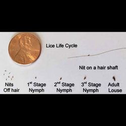 Lice Angeles - These are the different stages of the life cycle of lice. These are all removed with our non toxic treatment. 818-585-2826 call us or text!