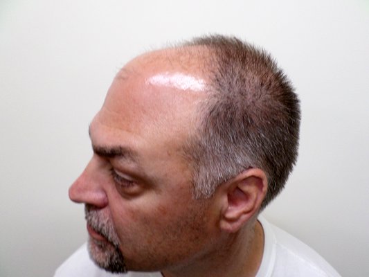 Robotic Hair Restoration Long Island 17 Fotos