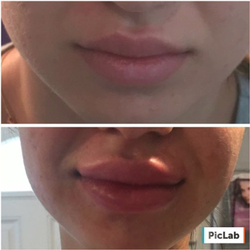 Dolce Aesthetics - Botox, Lip injection, Juvederm, Jaw Cheek Contouring, Non surgical nose jobs, Laser facials, Kybella, Voluma, Microneedling, Chemical peel