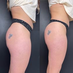 Evolve from Within Aesthetic MedSpa - Radiesse non-invasive BBL