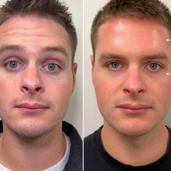 Dysport and EZ Gel