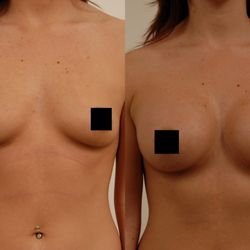 Beck Aesthetic Surgery - Dr. Joel Beck - A 24 year old female treated with breast augmentation using Natrelle Style 15, 339cc smooth round gel filled implants.