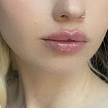 SkinSpirit - Bellevue - This is one hour after injections- the shape is perfection - Skin Care Near Me - Bellevue, Washington SkinSpirit - Bellevue - This is one hour after injections- the shape is perfection - Skin Care Near Me - Bellevue, Washington