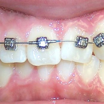 Ralph A Callender, DDS - PROGRESS:SELF LIGATING BRACES DAMON WIRE - Orthodontists Near Me - Los Angeles, California Ralph A Callender, DDS - PROGRESS:SELF LIGATING BRACES DAMON WIRE - Orthodontists Near Me - Los Angeles, California