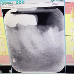 Capitol Perio - Broken tooth
