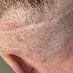 Advanced Medical Hair Institute - 7mm wide scar