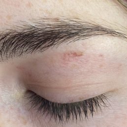 Spotlight beauty salon, burn from wax, and scab from the multiple rips Spotlight beauty salon, burn from wax, and scab from the multiple rips