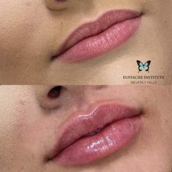 Lip Fillers