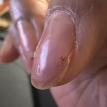 Nail Lux Atelier - Splinter hemorrhage from the damage on most of my fingers - Nail Salons Near Me - San Jose, California Nail Lux Atelier - Splinter hemorrhage from the damage on most of my fingers - Nail Salons Near Me - San Jose, California
