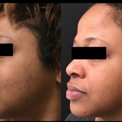 Boyd Detroit - Several months of consistent facials