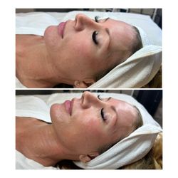 Savvy Skin Spa - Before and after of one of a kind Korean Glass Facial. See her sculpted jawline, lifted cheeks and stunning glow.