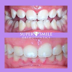 SuperSmile Orthodontics - Consultations to answer questions like: cost, timeframe, trays, clear or traditional Braces are always FREE