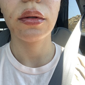 DermaVogue West - After - Skin Care Near Me - Murrieta, California
