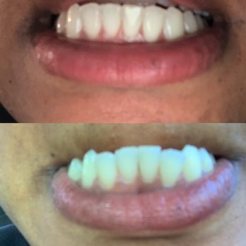 Griggs Orthodontics: Reginald Griggs, DDS - My lower teeth before and after wearing braces - Orthodontists Near Me - Castro Valley, California