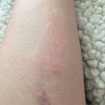 European Wax Center - Here is the bruise and skin removal! I hope it heals! - Waxing Near Me - Lone Tree, Colorado