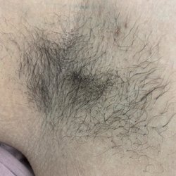 Susan’s Waxing - Underarms before waxing