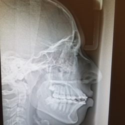 After 3 years of having braces by Dr. Lantigua, my son cannot close his mouth correctly because of malocclusion.