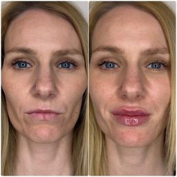 Results of my lip filler treatment right after appointment.