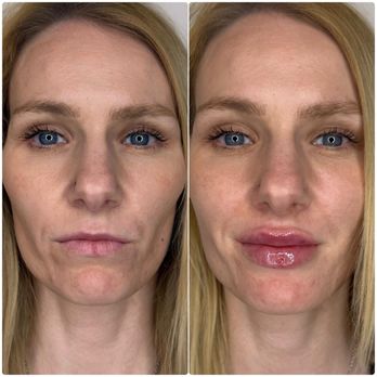 Iconic Beauty Medspa - Results of my lip filler treatment right after appointment. - Medical Spas Near Me - San Diego, California