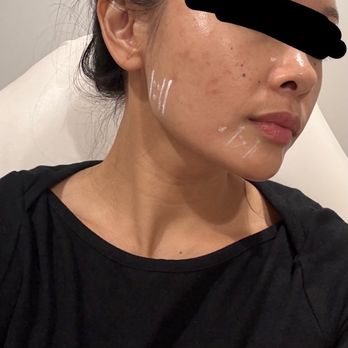 Belle Via Spa - Before the injection started - Medical Spas Near Me - Encinitas, California
